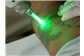Tratamento a Laser Para Remoção de Tatuagens